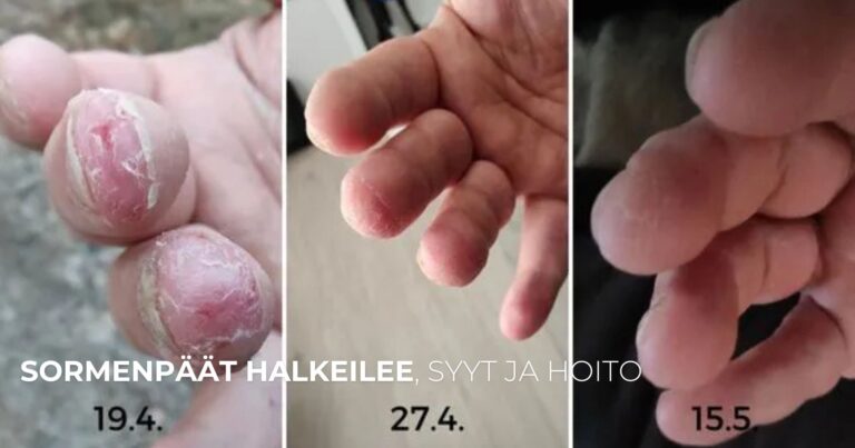Sormenpäät halkeilee, syyt ja hoito