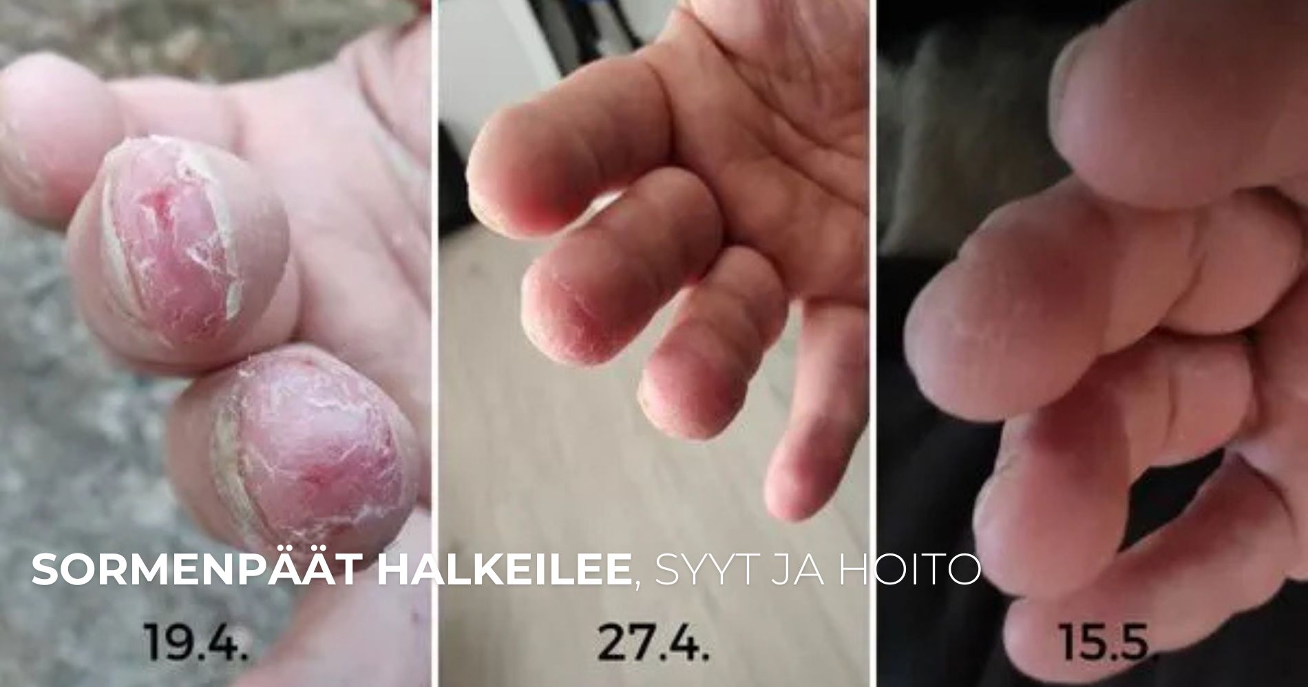 Sormenpäät halkeilee, syyt ja hoito