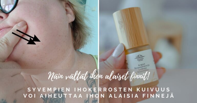 Näin vältät ihon alaiset finnit!