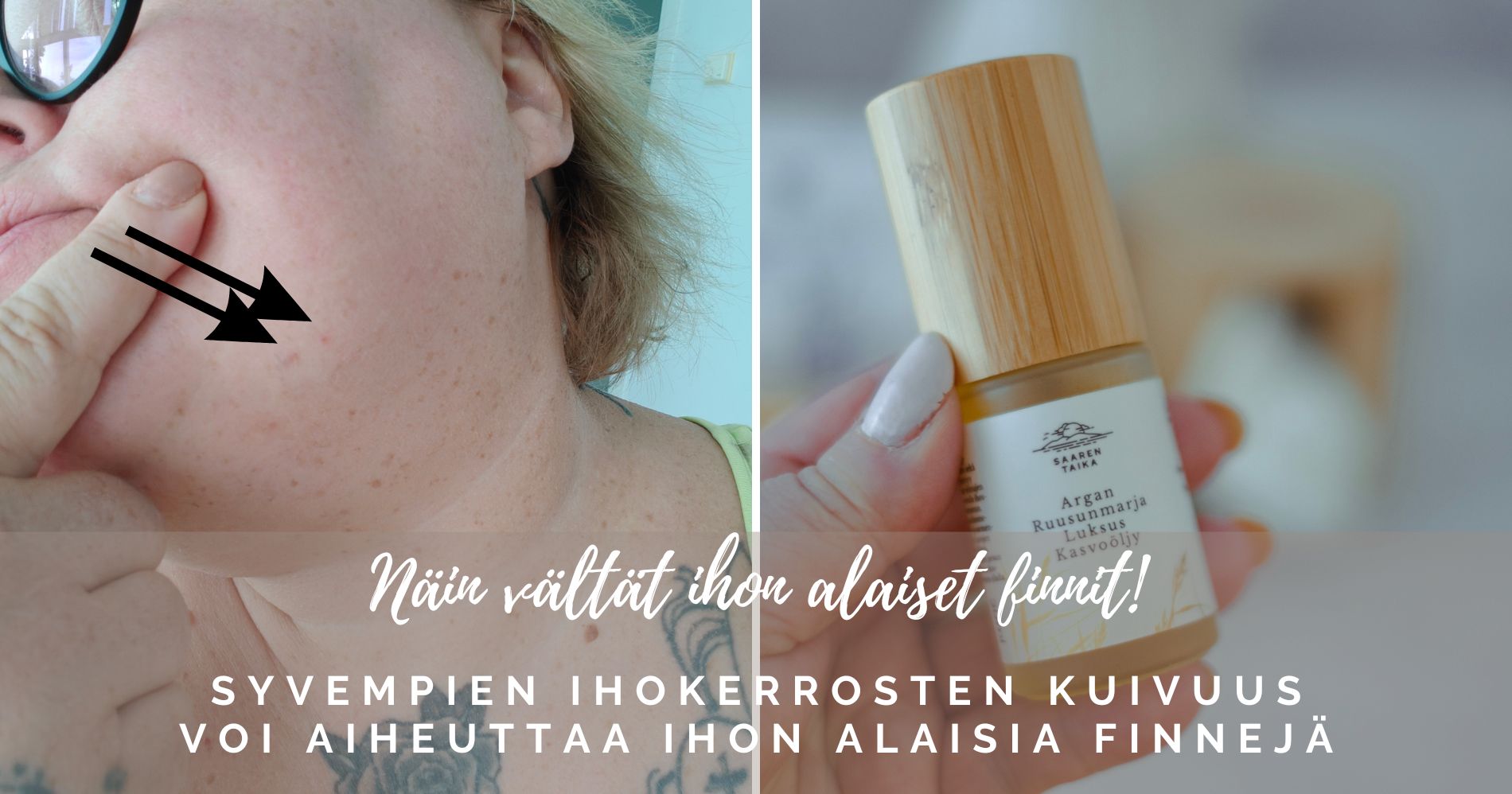 Näin vältät ihon alaiset finnit!