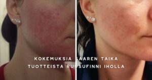 Tyrni Luksus Spa saippua on uskomaton tuote! Parin käyttö kerran jälkeen ruusufinnin näppylät kasvoista melkein hävisi, samoin punakkuus. Pesun jälkeen tosi pehmeän tuntuiset kasvot. Suosittelen!