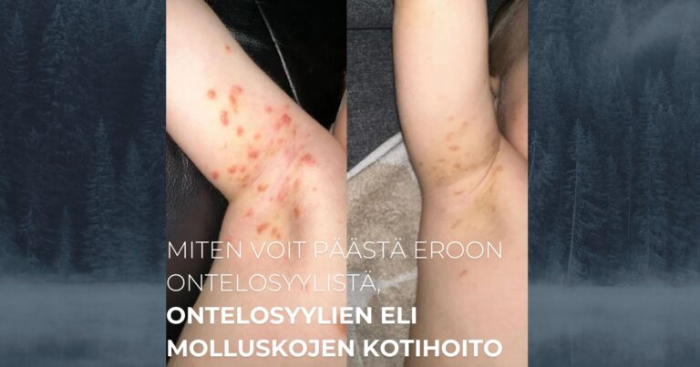 Miten voit päästä eroon ontelosyylistä, ontelosyylien eli molluskojen kotihoito