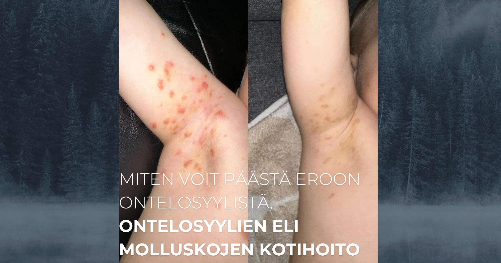 Miten voit päästä eroon ontelosyylistä, ontelosyylien eli molluskojen kotihoito