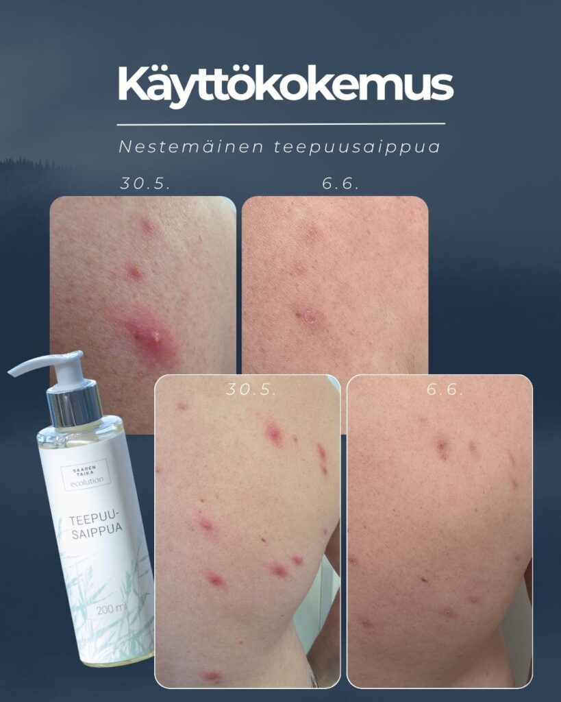 Selän räjähtänyt akne paremmaksi lähes välittömästi teepuusaippuan käytön aloittamisella. Märkäpäiset näpyt kuivuivat pois jo toisena päivänä ja alle viikossa selässä selkeä ero tulehtuneet kohdat rauhoittuneet ja ihon punoitus vähentynyt huomattavasti.