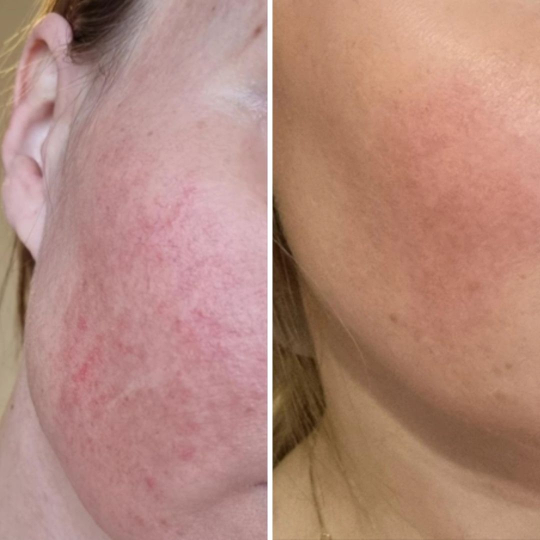 Kahden viikon Aktiivihiili Teepuusaippuan käytön aikana ruusufinni/couperosa ihoni on rauhoittunut ja posket tuntuvat pehmeiltä ja terveiltä. Viimeksi iho ollut näin hyvässä kunnossa muutama vuosi sitten. Tuntuu, että saippuasta on ollut heti helpotusta ikävään ja jopa kipeään vaivaani. Mielestäni poskeni eivät ole enää niin tulehtuneen eikä pahan näköiset kuin aiemmin.