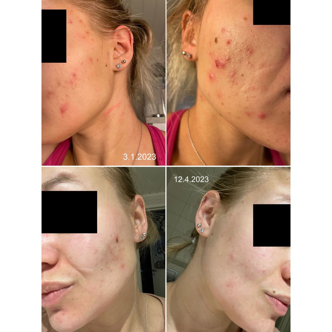 Hei, Halusin lähettää teille kiitokset! Akne ihoni on parantunut, Veera suolasaippuan käytön jälkeen. Kiitoskiitoskiitos. Olen taistellut aknen kanssa teini-iästä asti. Nyt parannellaan vain arpia. Liitteeksi kuva, ennen ja jälkeen! (Ennen kuvassa iho on ruskettunut - kiitokset kanarian auringon!)