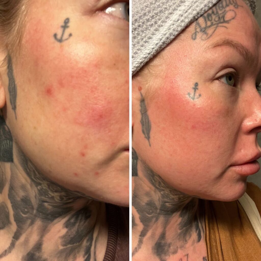 ”Kärsin lähes vuoden ajan erittäin kipeästä kasvojen ihosta. Koko homma oli shokki, sillä ihoni on ollut lähes aina erittäin hyvässä kunnossa. Jopa kosmetologi-tuttuni oli ihmeissään, että miten voi olla mahdollista, sillä ihoni on ollut lähes virheetön. Epäpuhtaudet ovat olleet erittäin kivuliaita. Olen aikasemminkin kokeillut Saaren Taika-tuotteita ja ollut tyytyväinen. Erityisen tyytyväinen olen nyt. Vihdoinkin ihoni alkaa palautumaan (toki arpia on ihoon jäänyt epäpuhtauksien takia). Olen käyttänyt teidän Veera suolasaippua palaa kasvojen pesuun ja pesun jälkeen suihkinut kasvoille ruusu-aloe kasvovettä. PELASTUS. Tuhannet kiitokset!!”