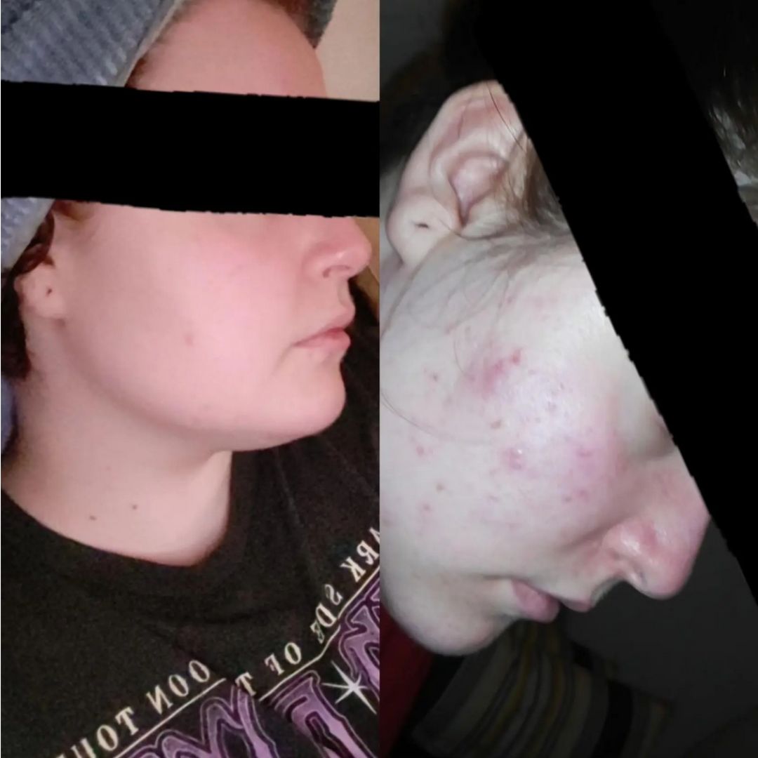 "Aivan mahtava tuote! Kosteuttaa, rauhottaa ja vähentää finnejä. Tästä tuli uusi suosikki ja tulokset näkyvät todella nopeasti!"