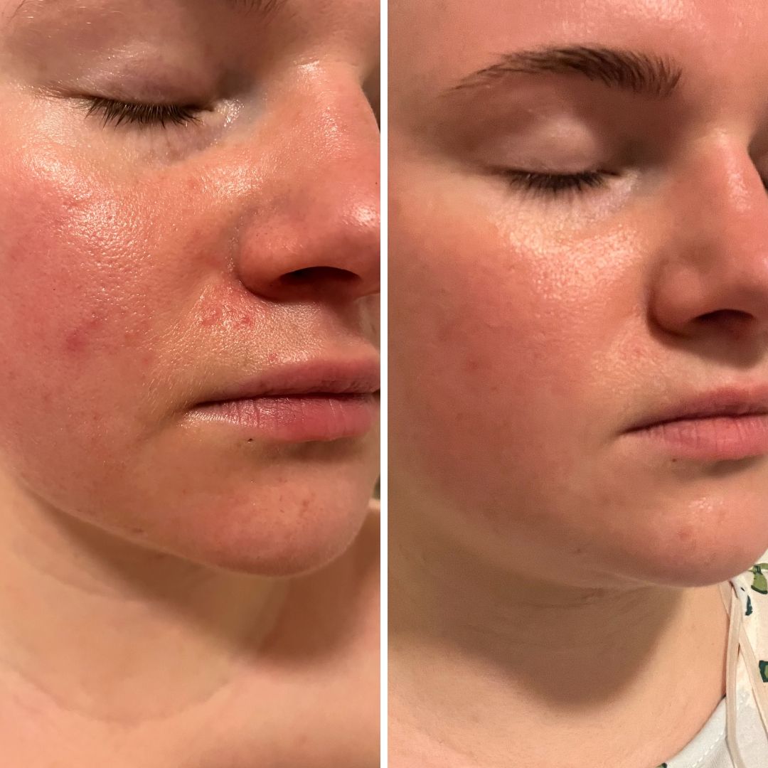 Ihohuokoset pienentyneet, ihon kuivuudesta johtuneet märkänäppylät ja kipeä nenänpieli-ihottuma parantunut alle kahden viikon C-vitamiiniseerumin käytöllä. Iho näyttää kuulaammalta ja kirkkaammalta.