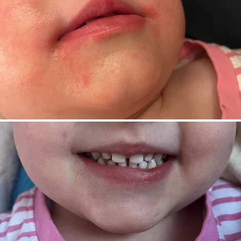 Taaperon punoittava suunympärystä parani yhdessä päivässä Saaren Taika Metsämikrobivoiteella!