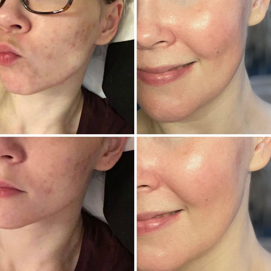 Teepuusaippua kokemus akne Moikka! Sain viime kesänä lahjaksi Saaren Taika teepuusaippua. Kärsin useita vuosia aknesta. Nyt olen käyttänyt sitä aktiivisesti, ja ihoni on parempi kuin koskaan aiemmin"