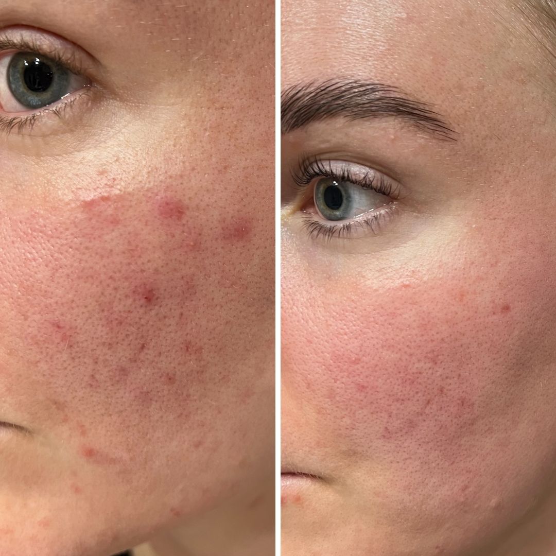 Ihossani on akne-/epäpuhtausongelmaa ja tuotteet auttavat niihin. Kasvovesi tuo ihanan raikkauden kasvoihin.