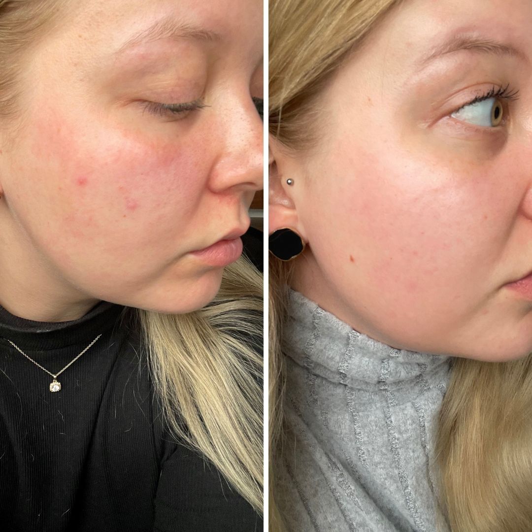 Epäpuhtaudet iholla on selvästi vähentyneet jo lyhyenkin käytön jälkeen. Myös kasvojen punoitus vähentynyt huomattavasti!
