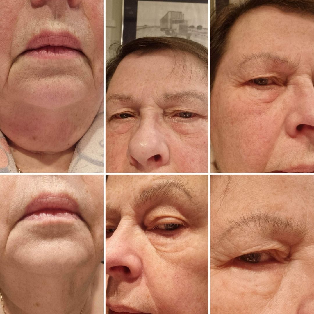 Ruusunmarja kasvovoide ennen ja jälkeen kuvat