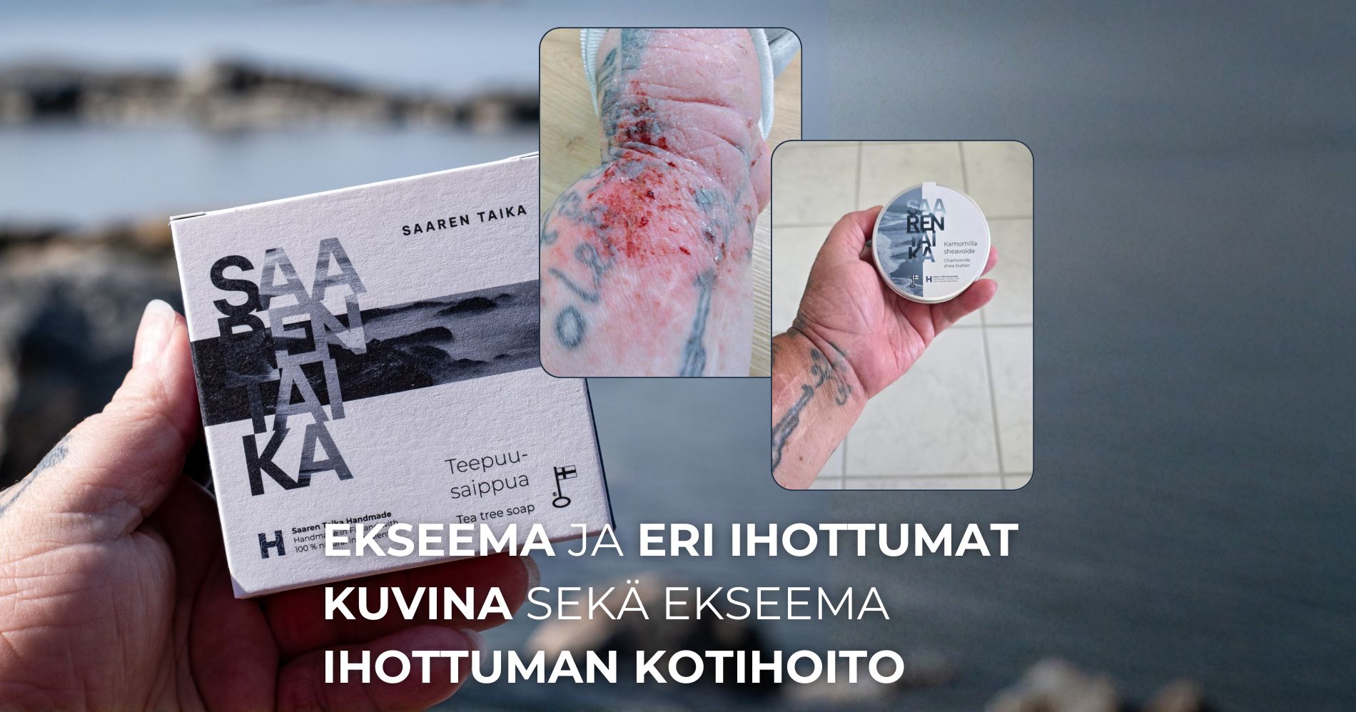 Ekseema ja eri ihottumat kuvina sekä ekseema ihottuman kotihoito