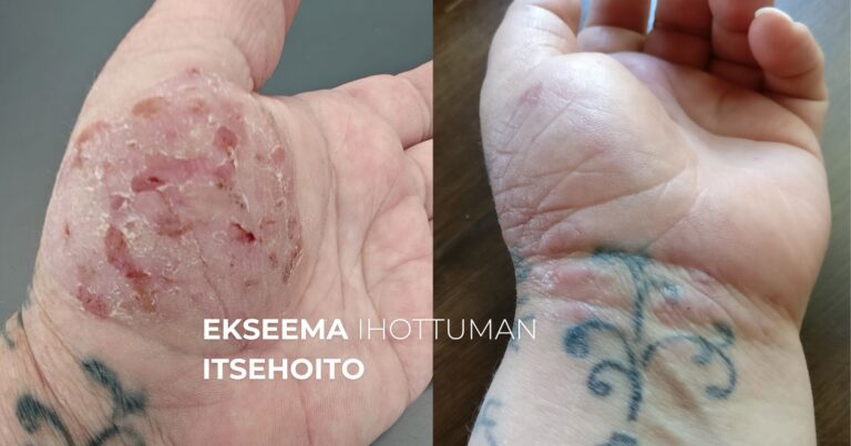 Ekseemat ovat laaja ryhmä tavallisia ihottumia. Ekseema tarkoittaa ihon pintaosien tulehdusta, joka pitempään jatkuessaan siirtyy ihon syvempiin osiin