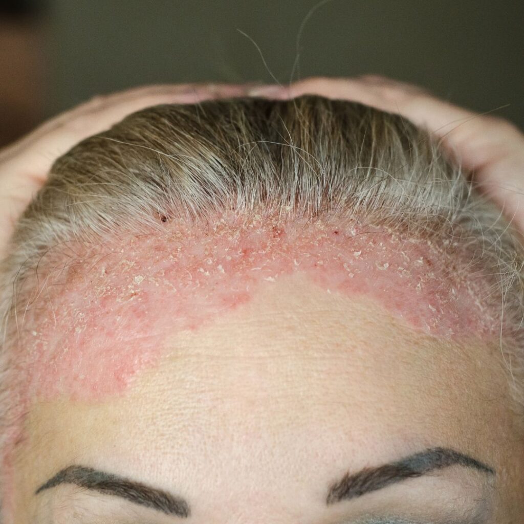 p-nahan-psoriasis-kutinaan-ja-hilseilyyn-tutkittu-apu
