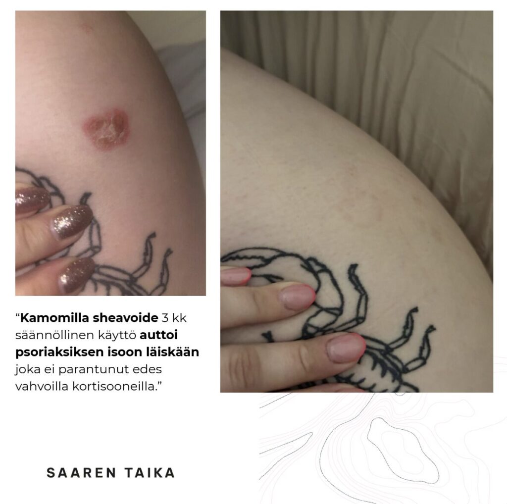 Käyttäjän ennen ja jölkeen kuvat psoriläiskästä joka on toisessa kuvassa lähes kokonaan kadonnut.