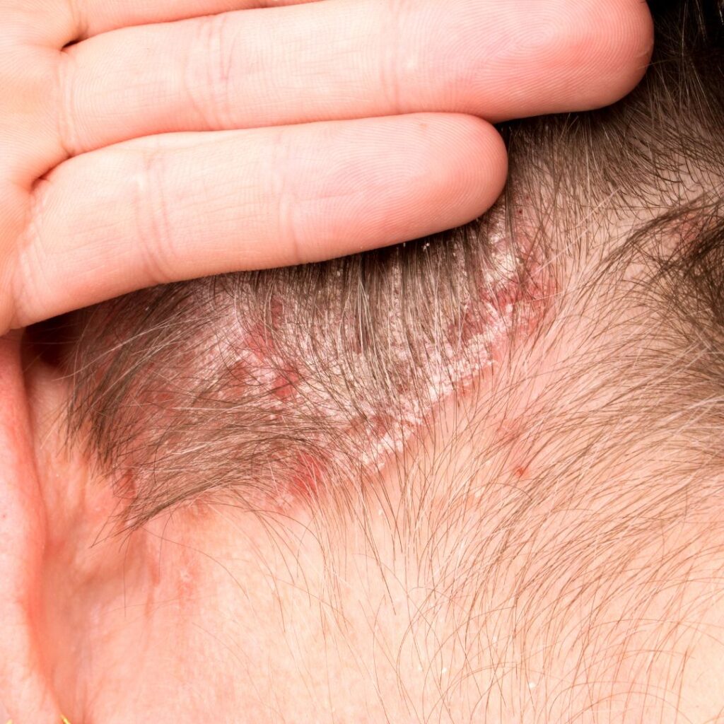 Miten tunnistaa psoriasis
