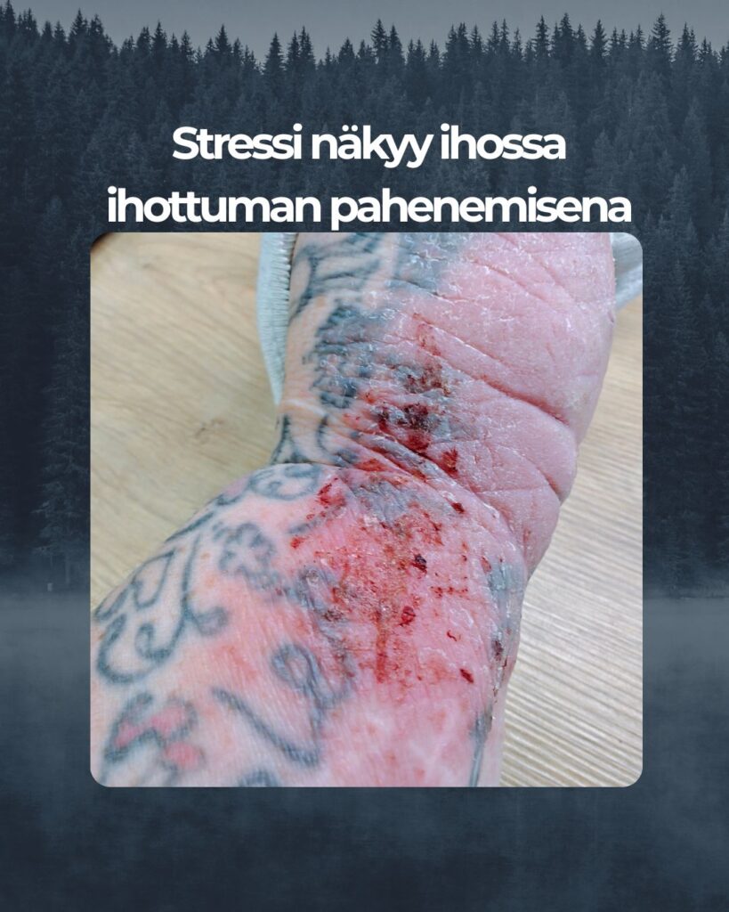 Stressi näkyy ihossa ihottuman pahenemisena
