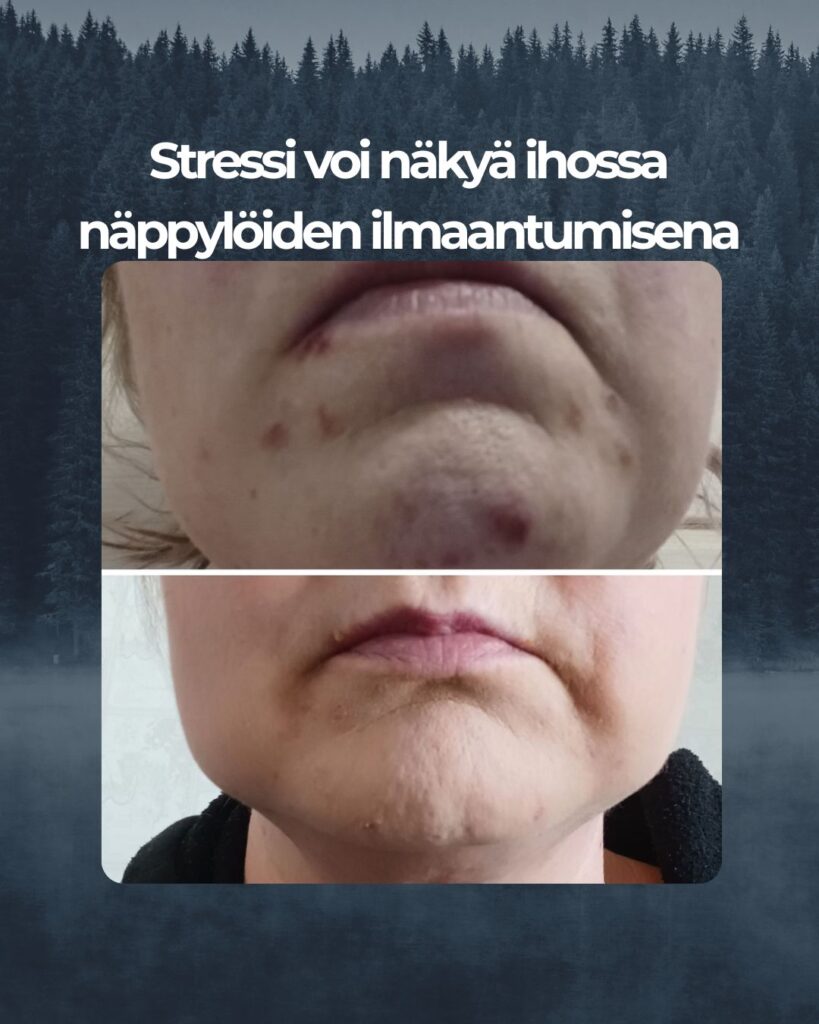 Kuvapalaute: En ole 42 vuoden ikään mennessä kärsinyt iho-ongelmista. Yhtäkkiä alkoi leukaan ilmestymään näppyjä joita vaan tuli ja tuli. Olin hetken jo täysin lamaantunut, kun joka aamu ja ilta ilmestyi uusi näppylä ja leuka näytti hirveältä. Rupesin joka aamu ja ilta pesemään kasvoni Teepuusaippualla ja pikkuhiljaa näpyt alkoivat häviämään eikä lisää enää ilmestynyt. Ensimmäinen kuva otettu 17.2 ja toinen tänään 15.3. Ero on huomattava ja ihoni on jälleen terve!