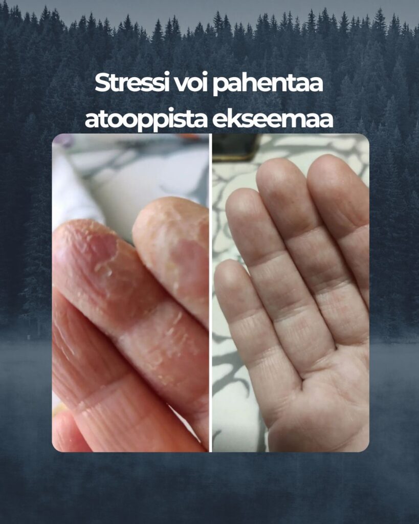 Kuvapalaute: Kamomilla Sheavoide Mahtava tuote. Käsiekseemaan olen joutunut käyttämään kortisonivoiteita. Päätin kokeilla Saaren Taika Kamomilla Sheavoidetta. Alussa käytin useamman kerran päivässä nyt rasvaan yöksi ja käsien iho on pysynyt hyvänä. Suosittelen. Tuote on riittoisa.
