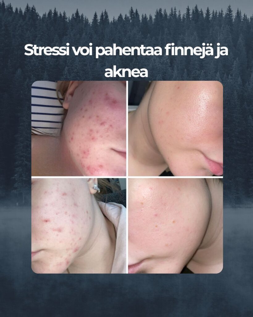 Kuvapalaute: Moikka! Ajattelin pistää teille kuvia siitä kuinka hyvin teidän Saaren Taika Teepuusaippua on auttanut minua todella pahassa aknessa. Vuoden olen käyttänyt teidän Teepuusaippuaa, enkä vaihtaisi sitä kyllä enään mihinkään muuhun. Kaikkea apteekki tuotteista marketti tuotteisiin on tullut testattua, mutta tämä saippua pelasti naamani. Olen tässä ollut ihan ihmeissään, että miten tämä on mahdollista ja aloin jo uskoa, että aknesta en pääse ikinä eroon. Plussaa on myös, että teepuusaippua on todella riittoisaa ja kestää pitkään!