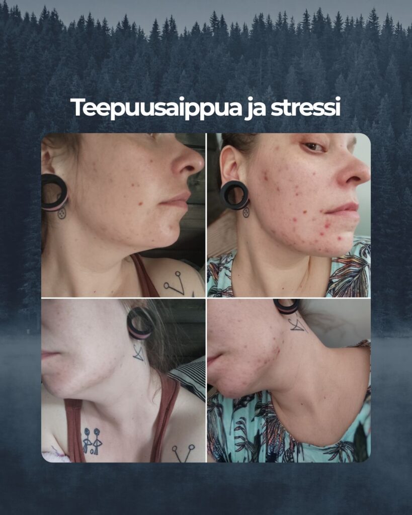 Kuvapalaute: Teepuusaippua auttoi parissa kuukaudessa rauhoittamaan maskin käytöstä ja stressistä kärsineen ihon. Muuhun en enää vaihda.