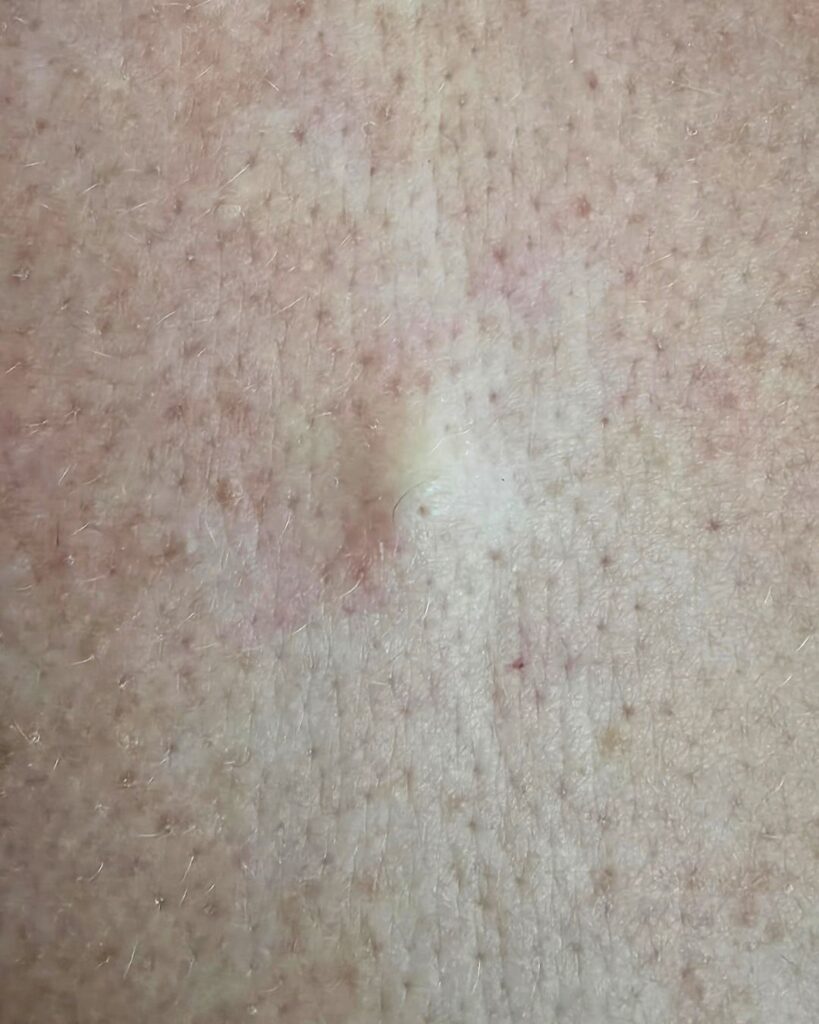 Aterooma eli talipatti tai sarveisontelo (epidermaalikysta) on ihon alle muodostuva hyvänlaatuinen kysta, joka syntyy talirauhasen tai karvatupen tiehyen tukkeutuessa