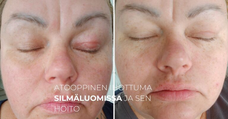 Atooppinen ihottuma silmäluomissa ja sen hoito