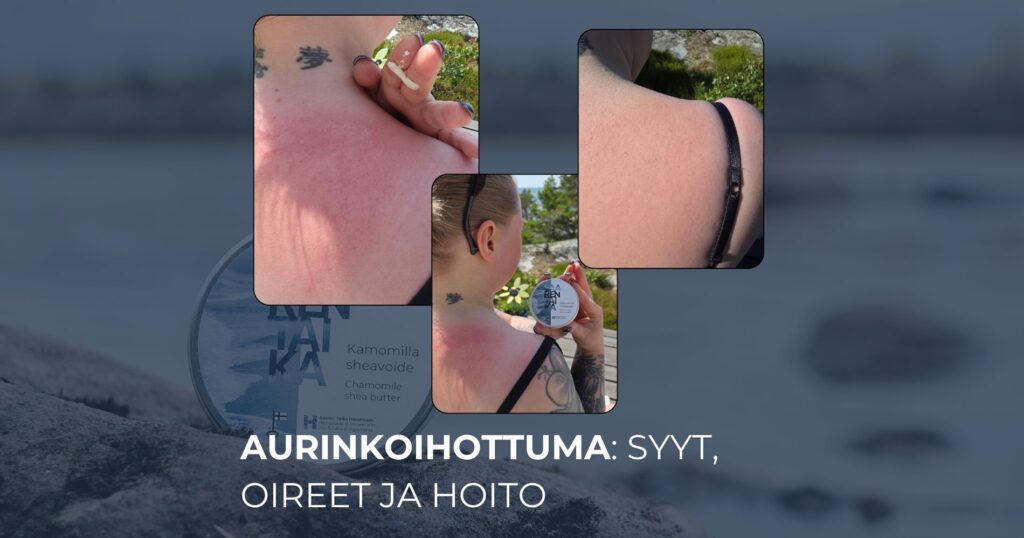 Aurinkoihottuma syyt, oireet ja hoito