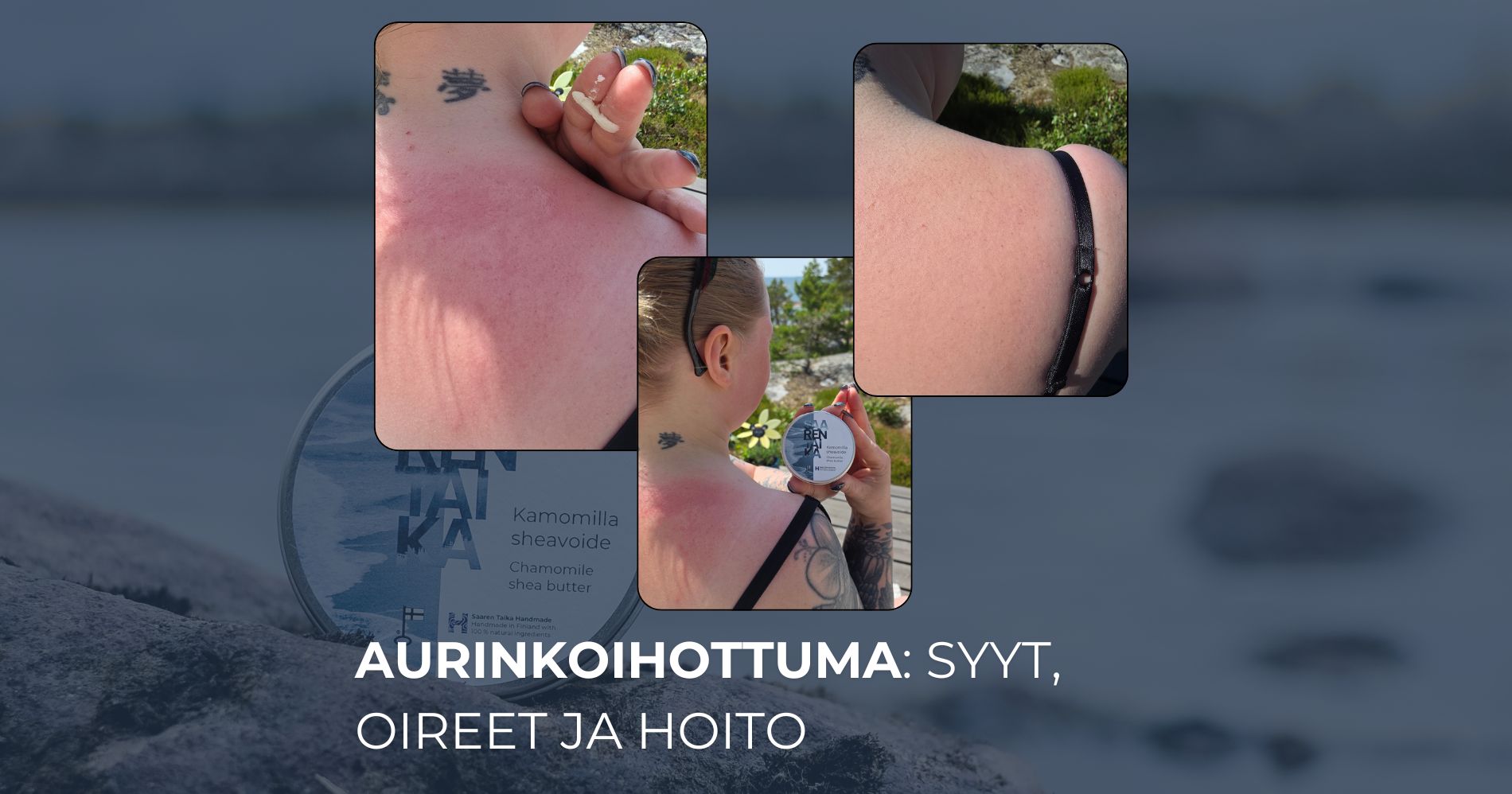 Aurinkoihottuma syyt, oireet ja hoito