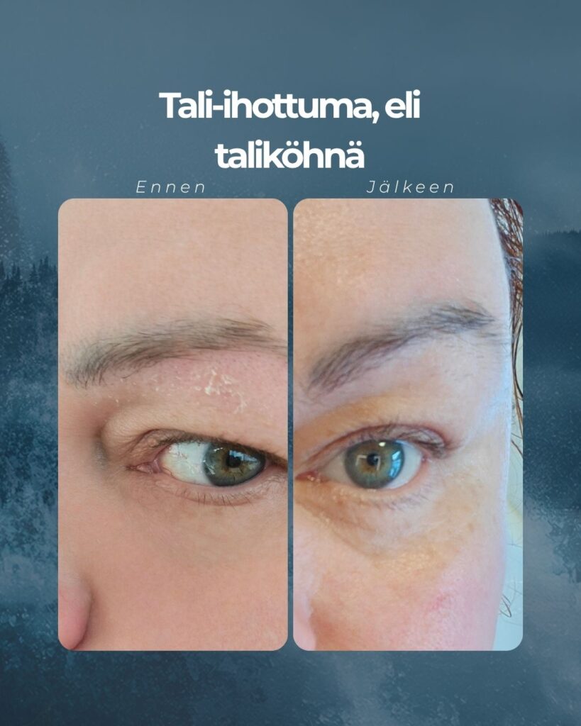 Taliköhnää kulmakarvoissa ennen-kuva ja rauhoittunut kulmakarvojen alue jälkeen-kuvassa