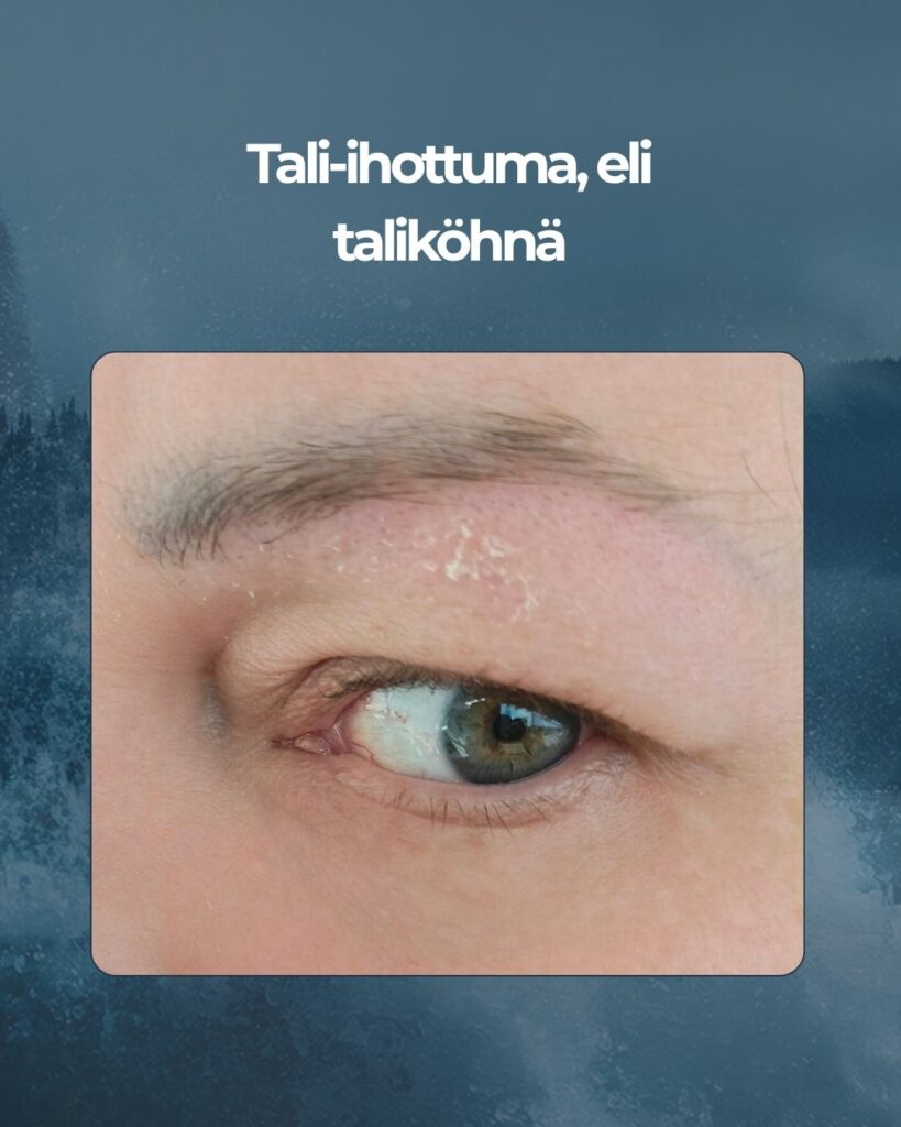 Taliköhnää kulmakarvoissa
