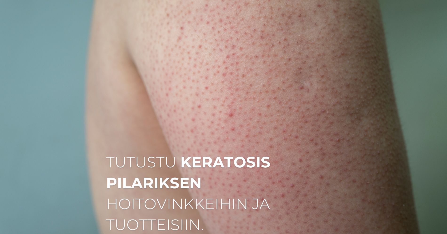 Tutustu keratosis pilariksen hoitovinkkeihin ja tuotteisiin. Pehmennä keratiini näppylät ja karhea iho kotikonstein tehokkaasti.