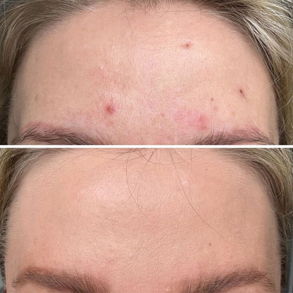 Azelaic Acid viikon käytöllä!! Mun jostain räjähtänyt otsa on pelastettu. Kuivatti finnit ja vei jäljet hetkessä pois! Best. Ei varmasti tarvitse kertoa kumpi on ennen ja kumpi jälkeen.