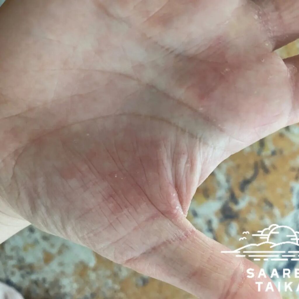 Kamomilla sheavoide Olen käyttänyt nyt vain 4 päivää kyseistä voidetta ja rakkulainen, märkivä ja kutiseva ihottuma on rauhoittunut jo todella hyvin. Suosittelen lämpimästi! Ainut miinus on haju, koska en tykkää hajusteista, mutta se on pieni miinus jos ihottumat paranee kokonaan! 😍