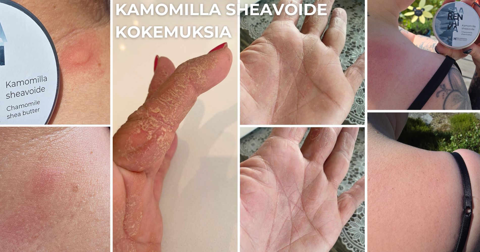 Kamomilla sheavoide kokemuksia atooppiselle iholle ja psoriasis iholle