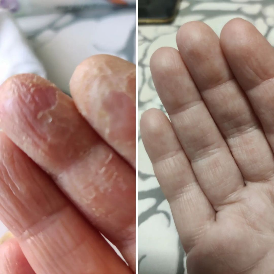 Kamomilla Sheavoide Mahtava tuote. Käsiekseemaan olen joutunut käyttämään kortisonivoiteita. Päätin kokeilla Saaren Taika Kamomilla Sheavoidetta. Alussa käytin useamman kerran päivässä nyt rasvaan yöksi ja käsien iho on pysynyt hyvänä. Suosittelen. Tuote on riittoisa