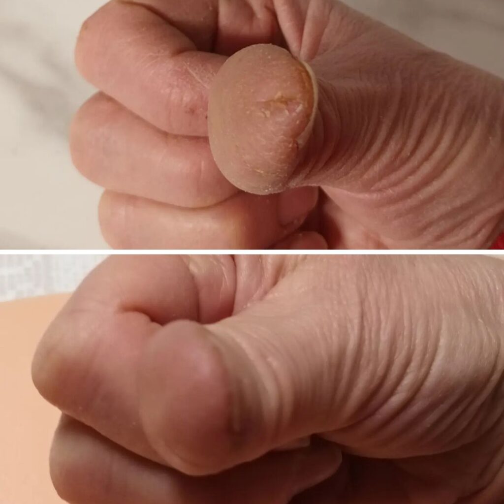 Runsaassa viikossa parani peukalonpääni alkava haavauma. Joka vuosi olen ollut ongelmissa talvisin sormenpäideni auetessa. Ne ovat niin kipeitä pahimmillaan, etten voi tehdä normaaleja kotitöitä.