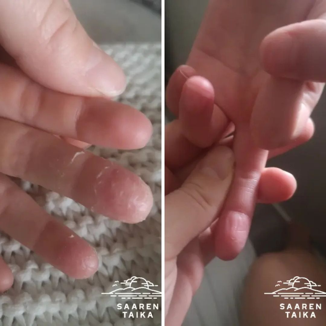 Kamomilla sheavoide Tämä on oikea ihmevoide! Tilasin arvosteluiden perusteella, koska alle kouluikäisellä tytöllä ollut pitkään todella paha atooppinen ihottuma kahden sormen päässä. Olemme kokeilleet vaikka mitä voiteita tuloksetta. Kun aloitimme käytön, tytöllä oli lisäksi sormessa ärtyisä haava, joka oli kipeä ja johtui ihottumasta. Kerkesimme käyttää tuotetta pari kolme päivää, kun tyttö sanoi ettei häntä enää satu ja tarkistaessani sormien iho oli lähes kokonaan parantunut haava mukaan lukien. Jatkamme käyttöä!