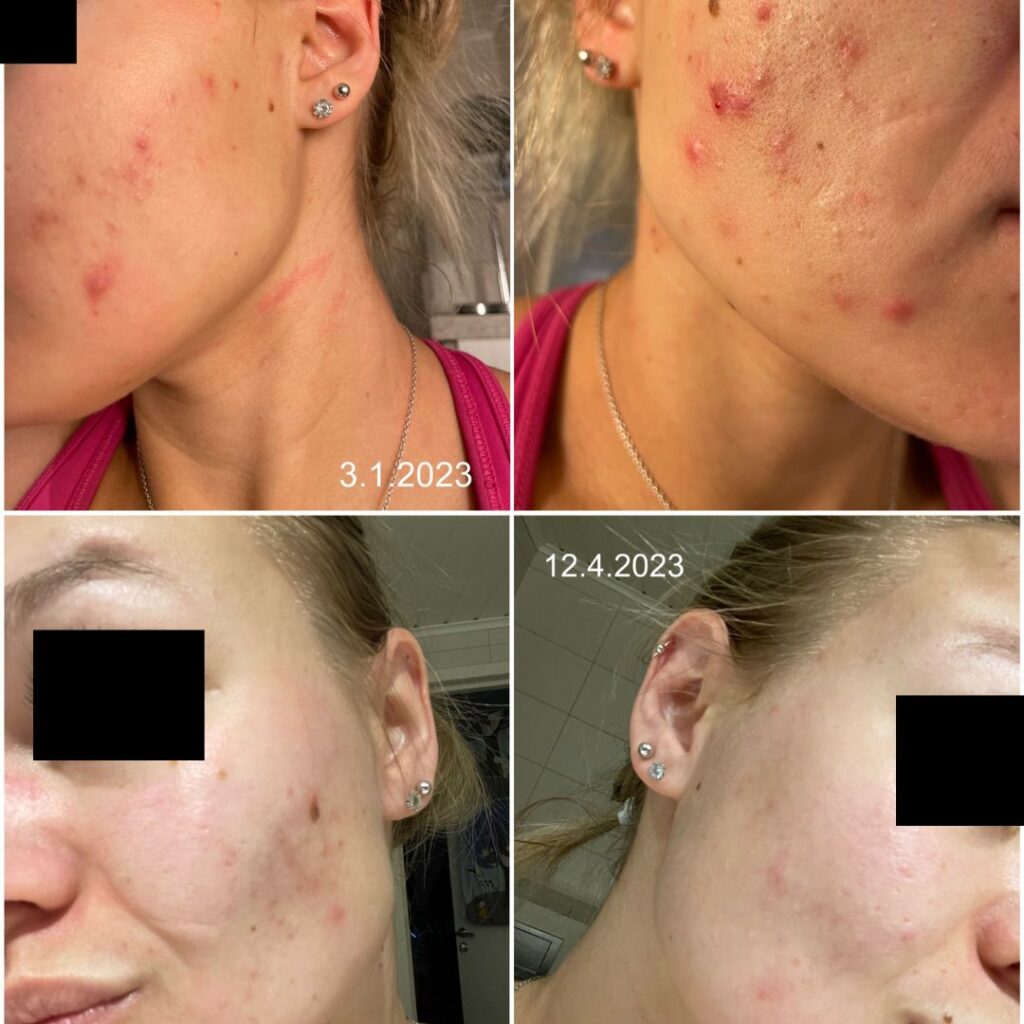 Aknen paikallishoito Veera Suolasaippualla ennen ja jälkeen kuvat
