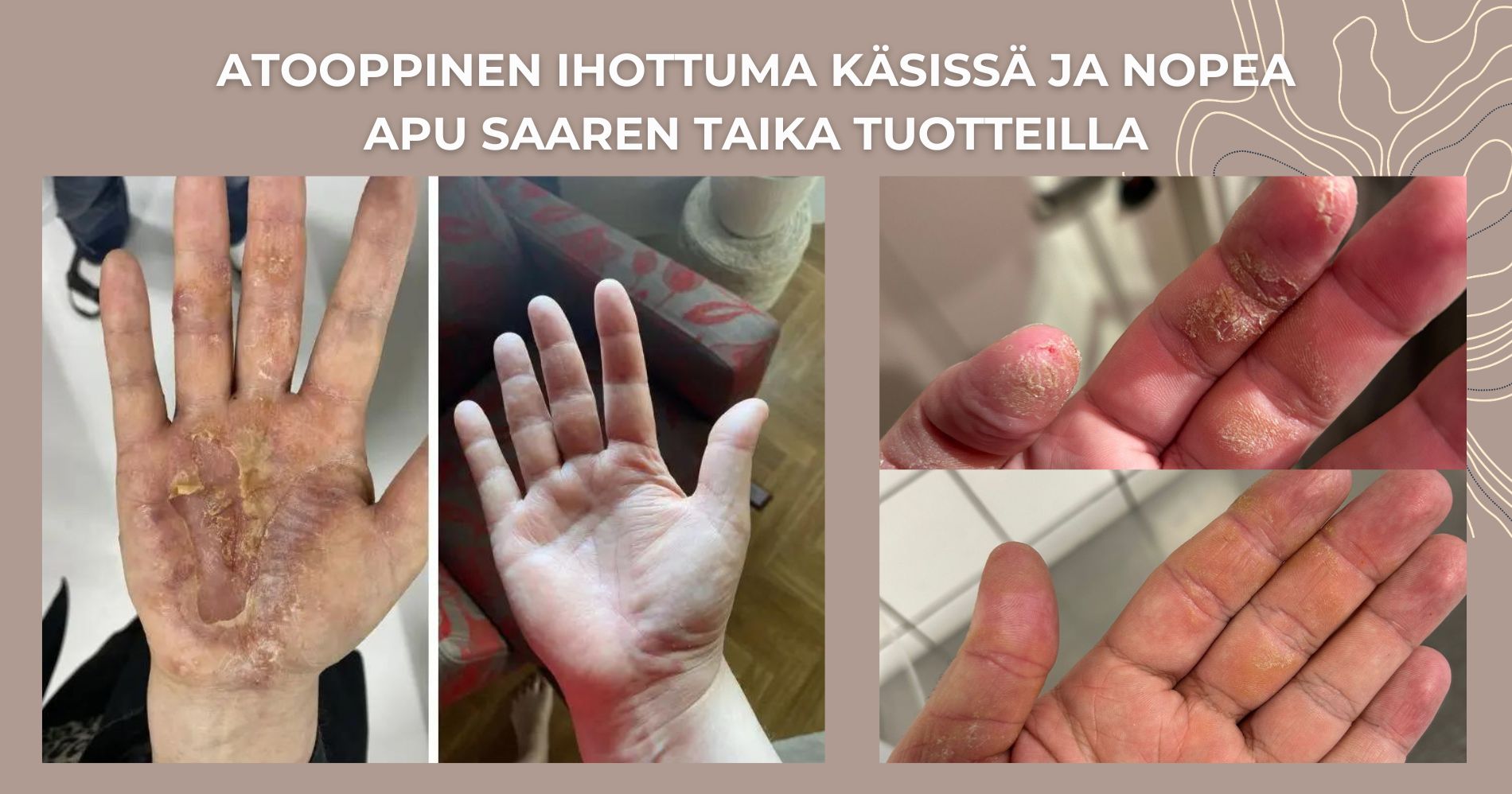 Atooppinen ihottuma käsissä ja nopea apu Saaren Taika tuotteilla