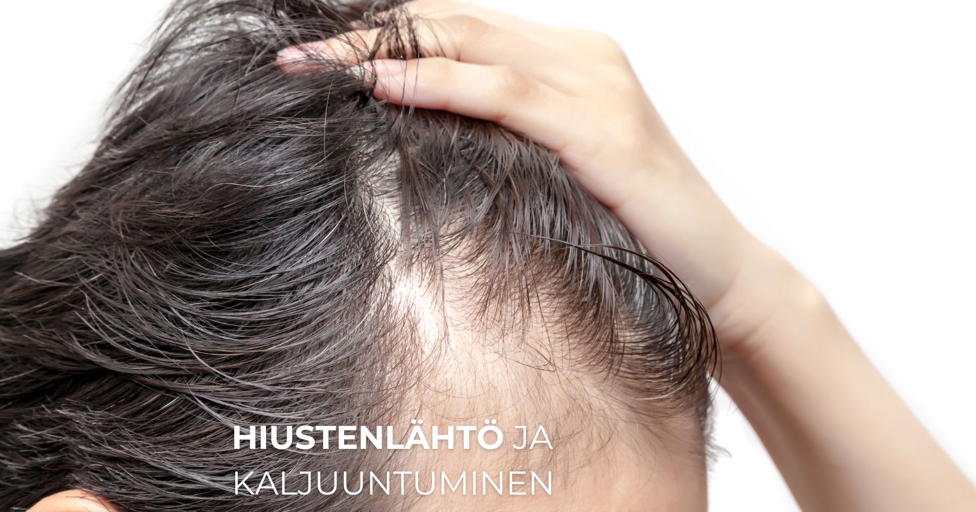 Hiustenlähtö ja kaljuuntuminen