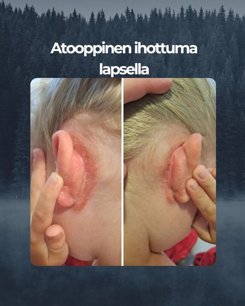 7v atoopikon korvantaustat on saatu vihdoin pysymään kunnossa, kiitos teidän kamomilla sheavoiteelle! Tässä kuvassa ei ole edes pahimmillaan... Kortisonikuureilla ihon sai siistiksi, mutta nopeesti kuurin loputtua paheni taas.