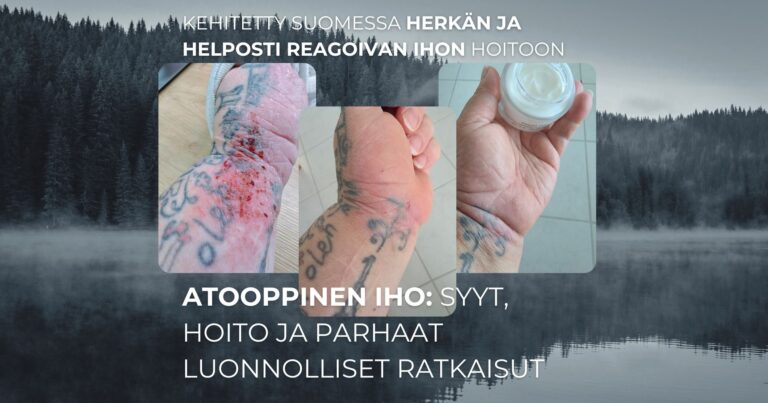 Atooppinen iho Syyt, hoito ja parhaat luonnolliset ratkaisut
