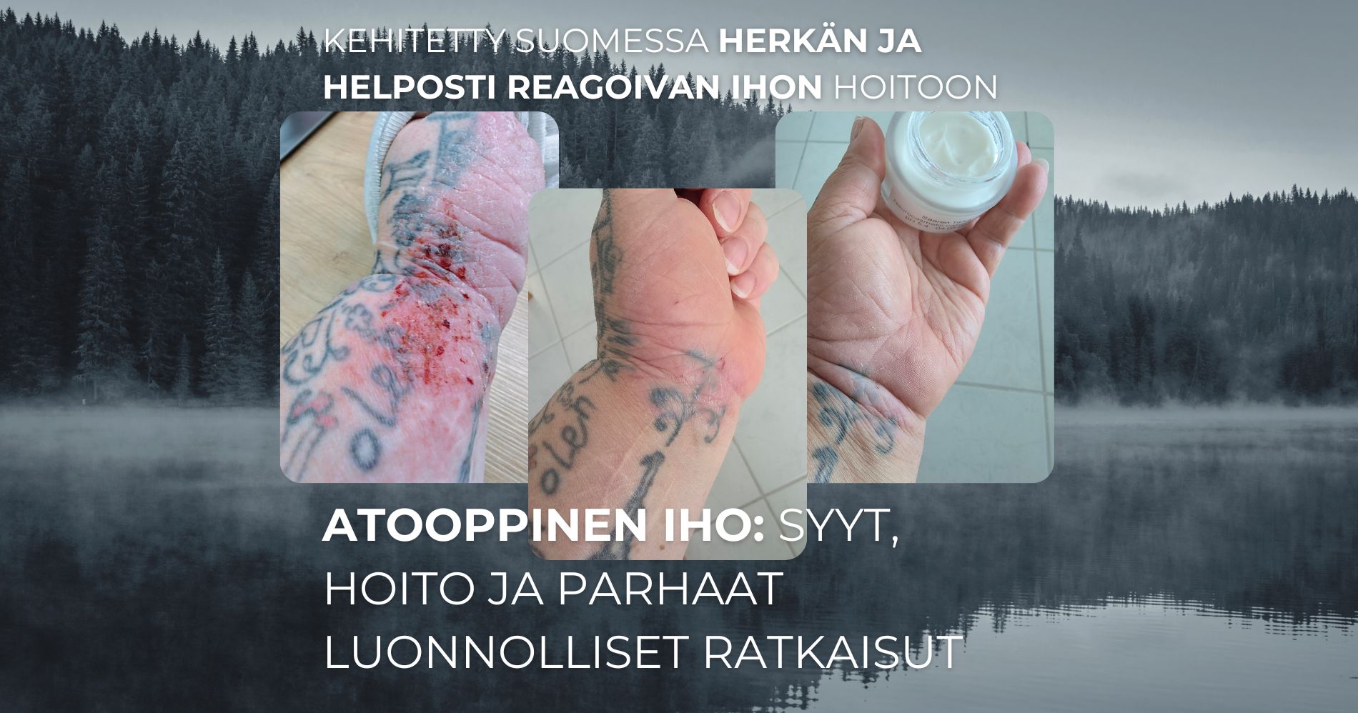Atooppinen iho Syyt, hoito ja parhaat luonnolliset ratkaisut