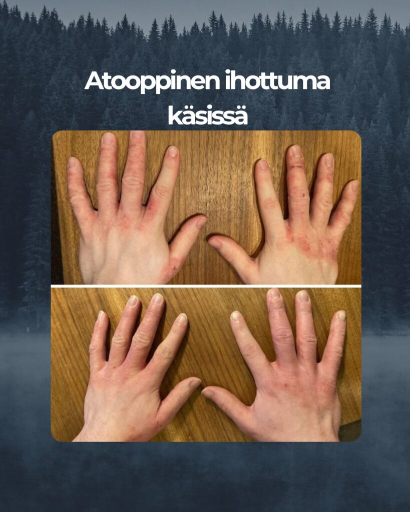 Hei! Super kiitokset Saaren Taika pala Teepuusaippuasta ja sen tuomasta avusta aikuisen poikani iho-ongelmaan. Kaikkea kokeilimme apteekkituotteista lähtien vaan sitten ajattelin, että jospa vielä tätä testaamme. Ja kyllä kannatti: eka kuvassa on lähtötilanne ja sitten kuva käsistä vajaan kahden viikon käytön jälkeen. Käsissä oli atooppista ihottumaa ja iho kutisee, hilseilee ja on haavoilla. Onhan sitä vielä hieman edelleenkin mutta tilanne on huomattavasti parempi ja mieli sen myötä helpottunut. Ja on hyvä jatkaa!!!