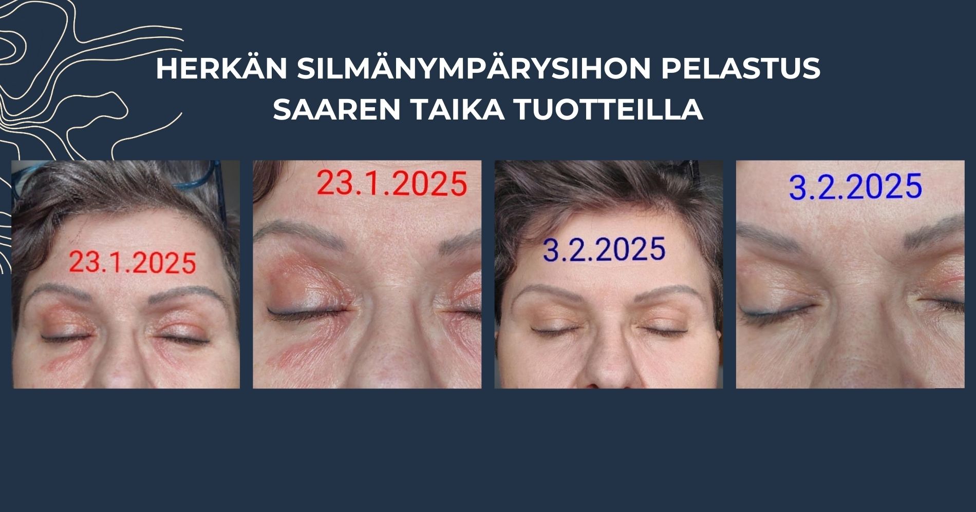 Herkän silmänympärysihon pelastus Saaren Taika tuotteilla