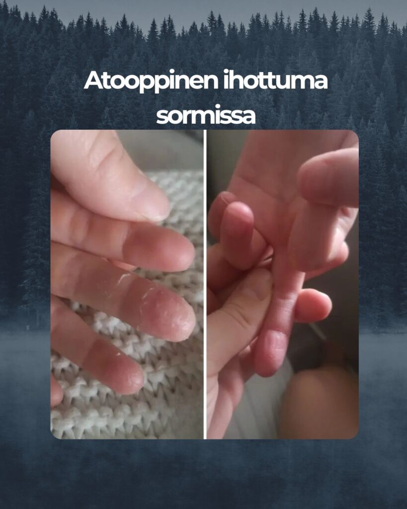 Kamomilla sheavoide Tämä on oikea ihmevoide! Tilasin arvosteluiden perusteella, koska alle kouluikäisellä tytöllä ollut pitkään todella paha atooppinen ihottuma kahden sormen päässä. Olemme kokeilleet vaikka mitä voiteita tuloksetta. Kun aloitimme käytön, tytöllä oli lisäksi sormessa ärtyisä haava, joka oli kipeä ja johtui ihottumasta. Kerkesimme käyttää tuotetta pari kolme päivää, kun tyttö sanoi ettei häntä enää satu ja tarkistaessani sormien iho oli lähes kokonaan parantunut haava mukaan lukien. Jatkamme käyttöä!